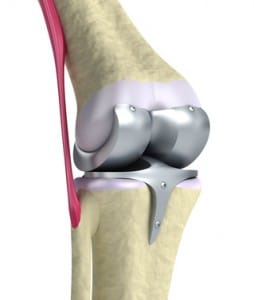 Protesi al ginocchio