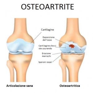 Artrite ginocchio