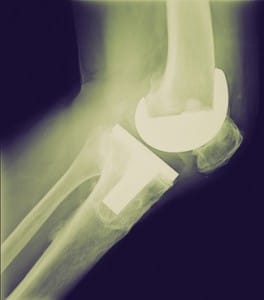 Protesi radiografie