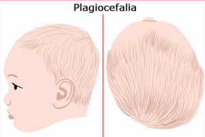 Diagnosi e cura della plagiocefalia